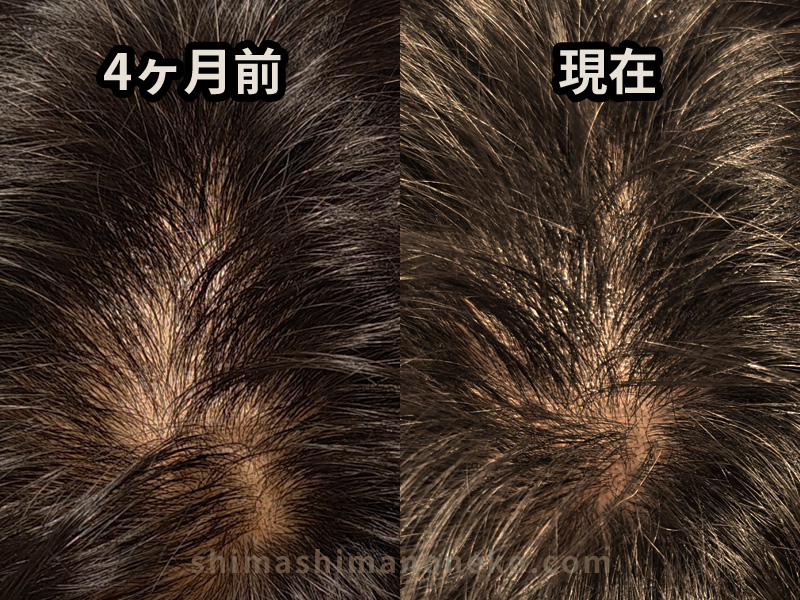 Crown before/after four months of minoxidil